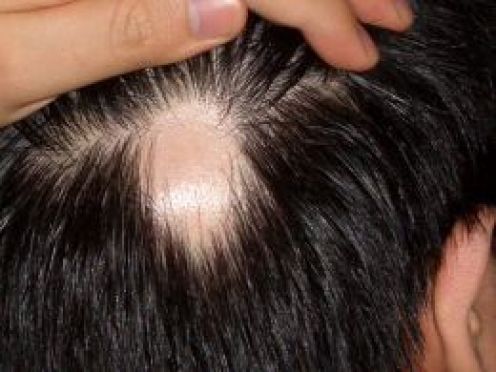 Alopecija areata