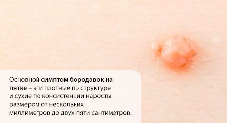 Karpis ant kulno: ką daryti?