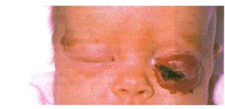 Apatinio voko hemangioma.