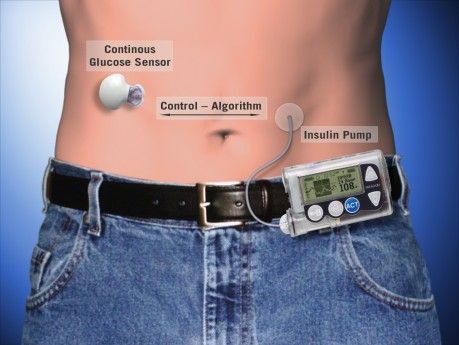 Dirbtinė kasa diabetui