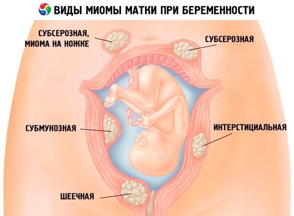 hipertenzija miomos abortas