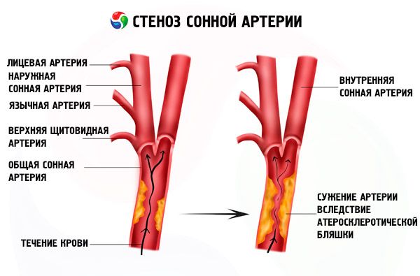arterijos stenozė ir hipertenzija geriausias kepimo aliejus širdies sveikatai
