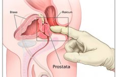 erekcija po prostatos masažo
