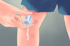 Edema Is Migdolų įkandimo Kaip Ir Ka Pasalinti Kompetentiskai Apie Sveikata Ilive