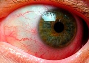 hipertenzija ir akių angiopatija