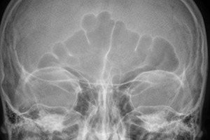 Priesinio Sinuso Fistula Priezastys Simptomai Diagnozė Kompetentiskai Apie Sveikata Ilive