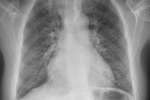 Plaučių hipertenzijos, prognozės ir gydymo požymiai - Vaskulitas November