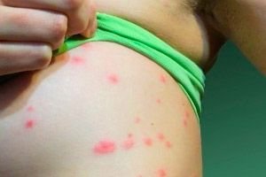 Psoriazė Vaikams Priezastys Simptomai Diagnozė Gydymas Kompetentiskai Apie Sveikata Ilive