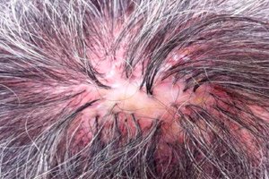 Iskirpimas Folikulitu Kenko Kaip Alopecijos Priezastis Kompetentiskai Apie Sveikata Ilive
