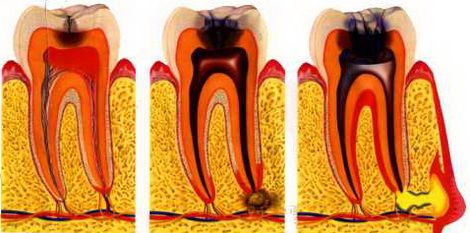 Dantų skausmas po pripildymo 